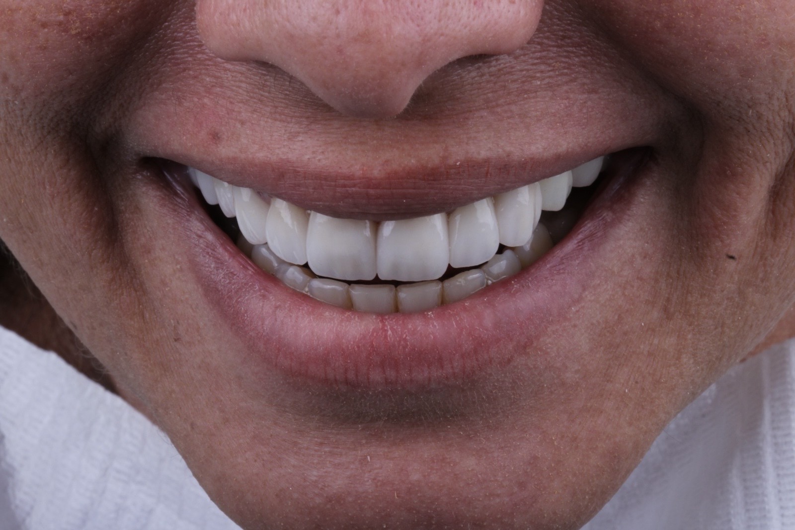 Sorriso confiante após facetas de porcelana