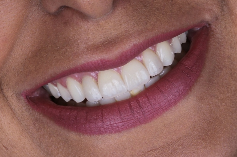 Resultado duradouro com lentes de porcelana