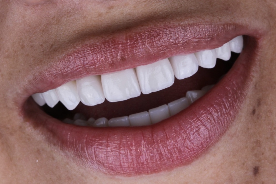 Sorriso natural após lentes de contato dental