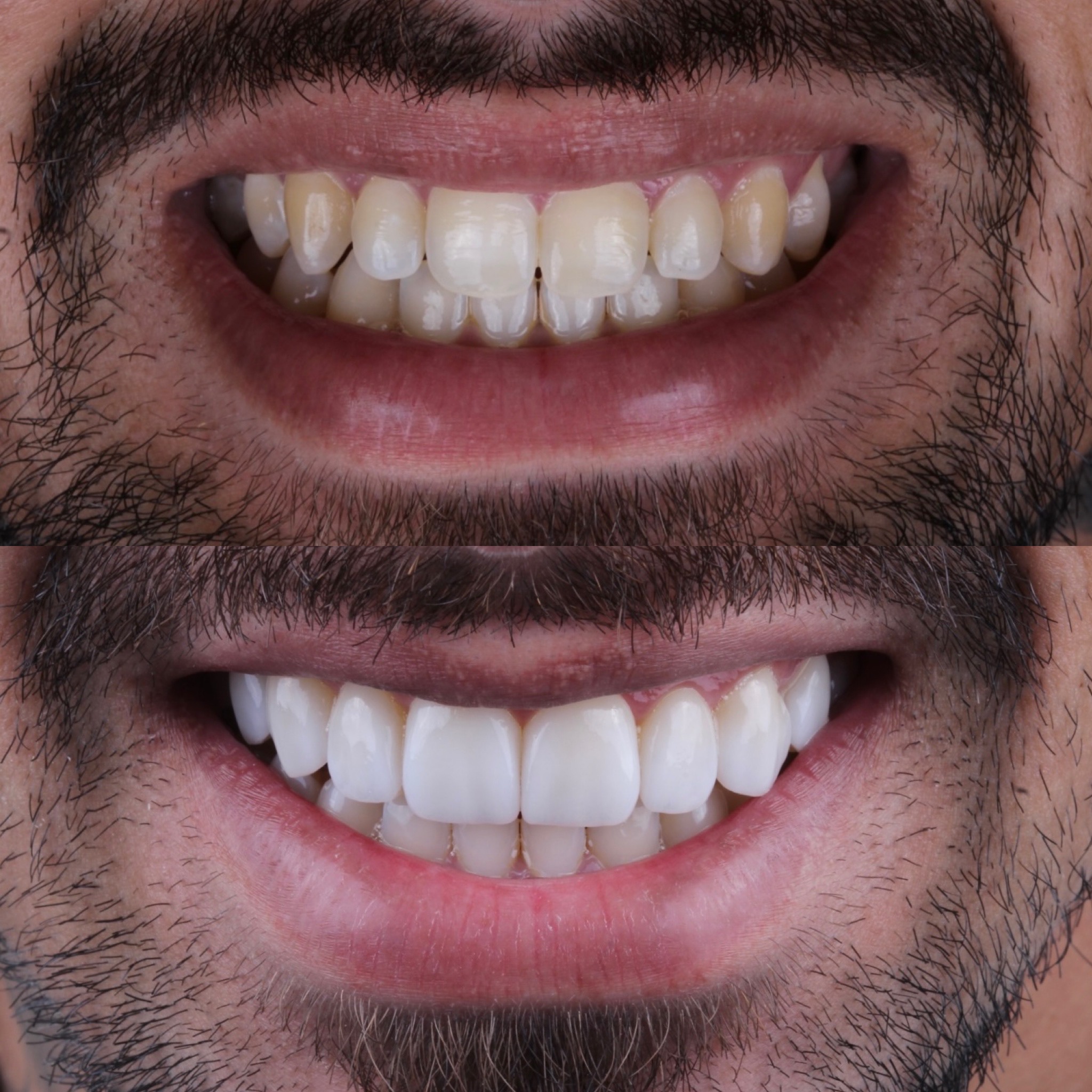 Resultado real de lente de contato dental
