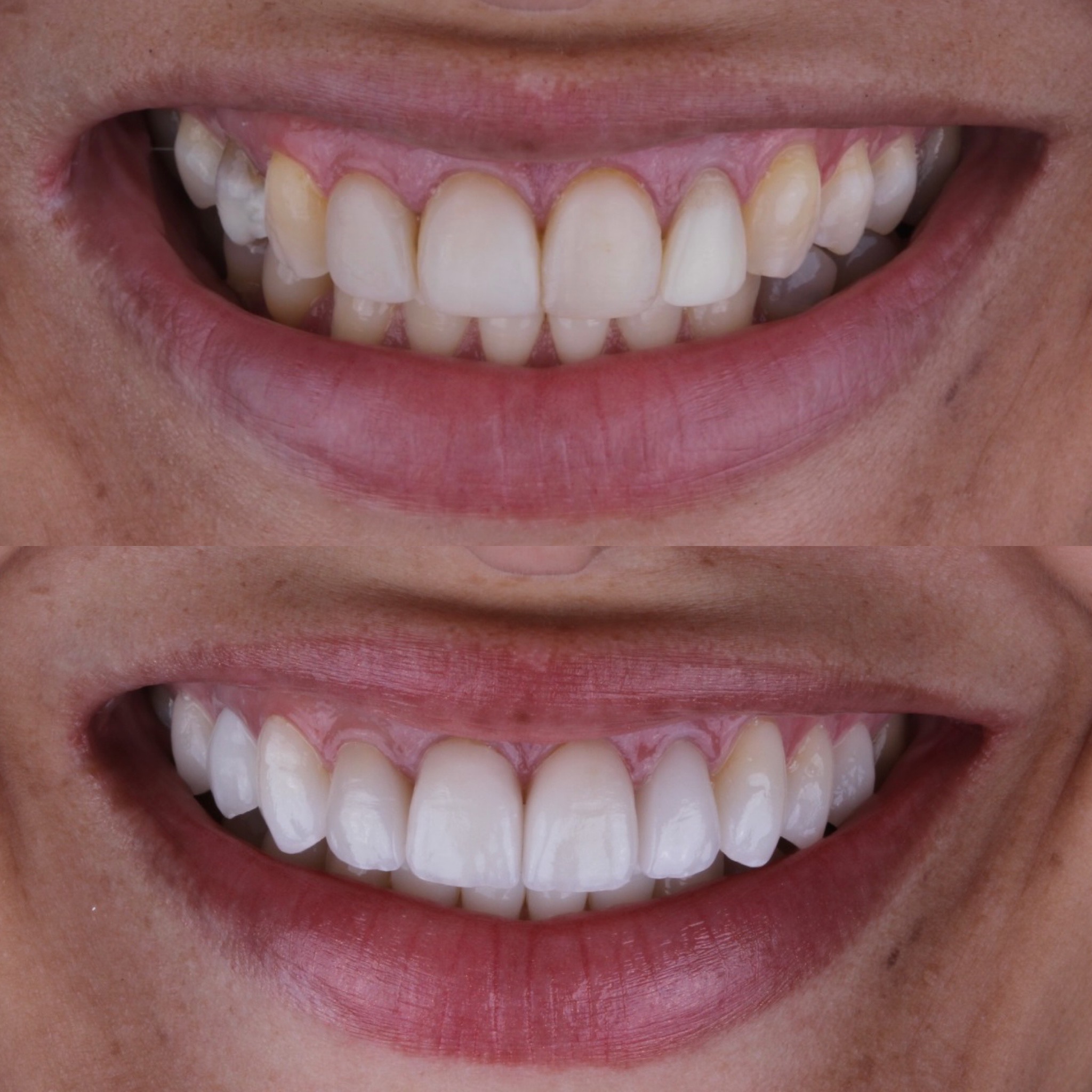 Resultado real de faceta de porcelana