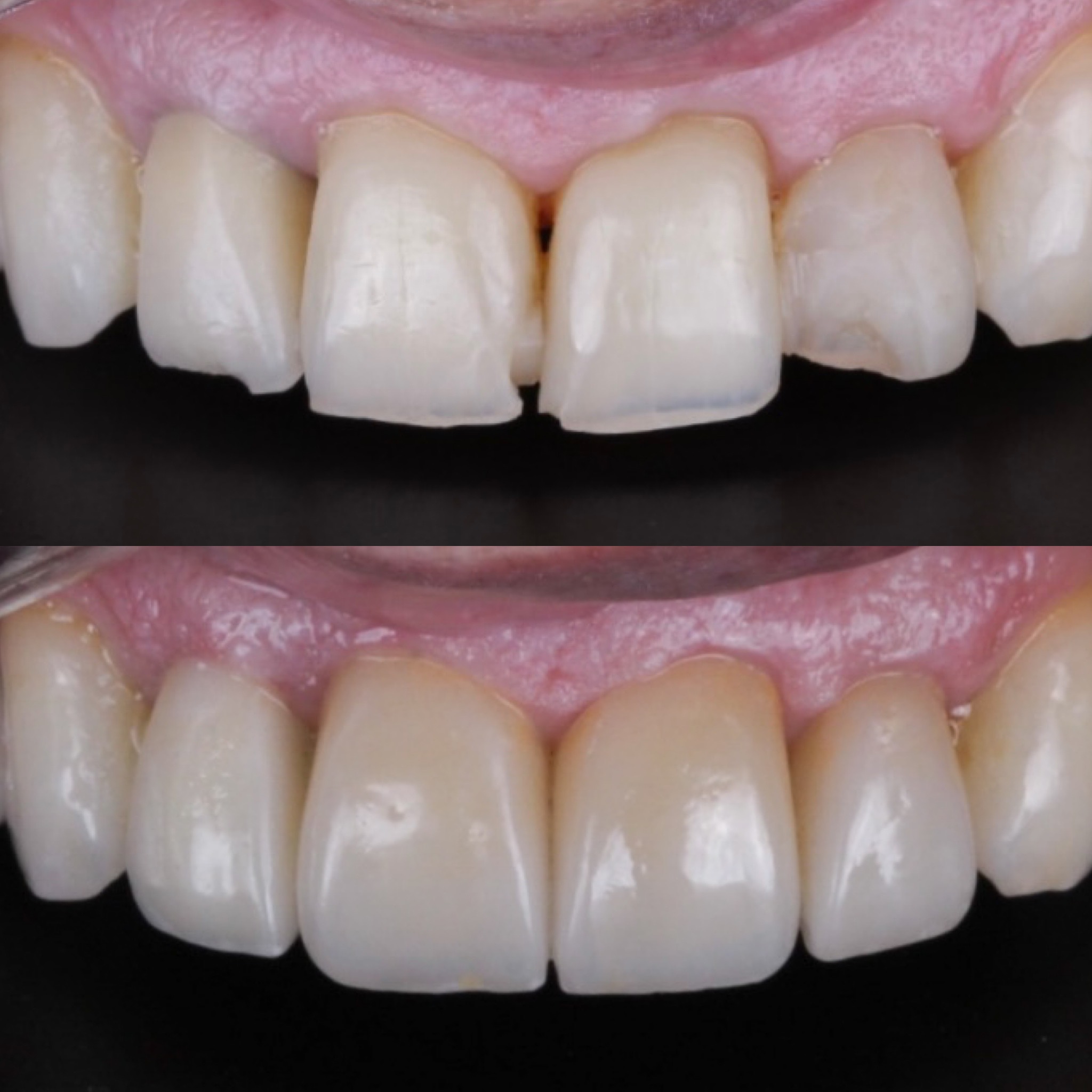 Resultado real de sorriso transformado