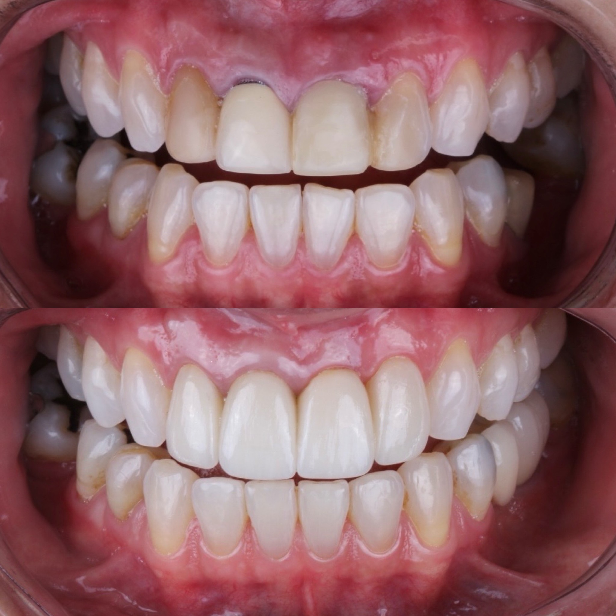 Resultado real de sorriso transformado