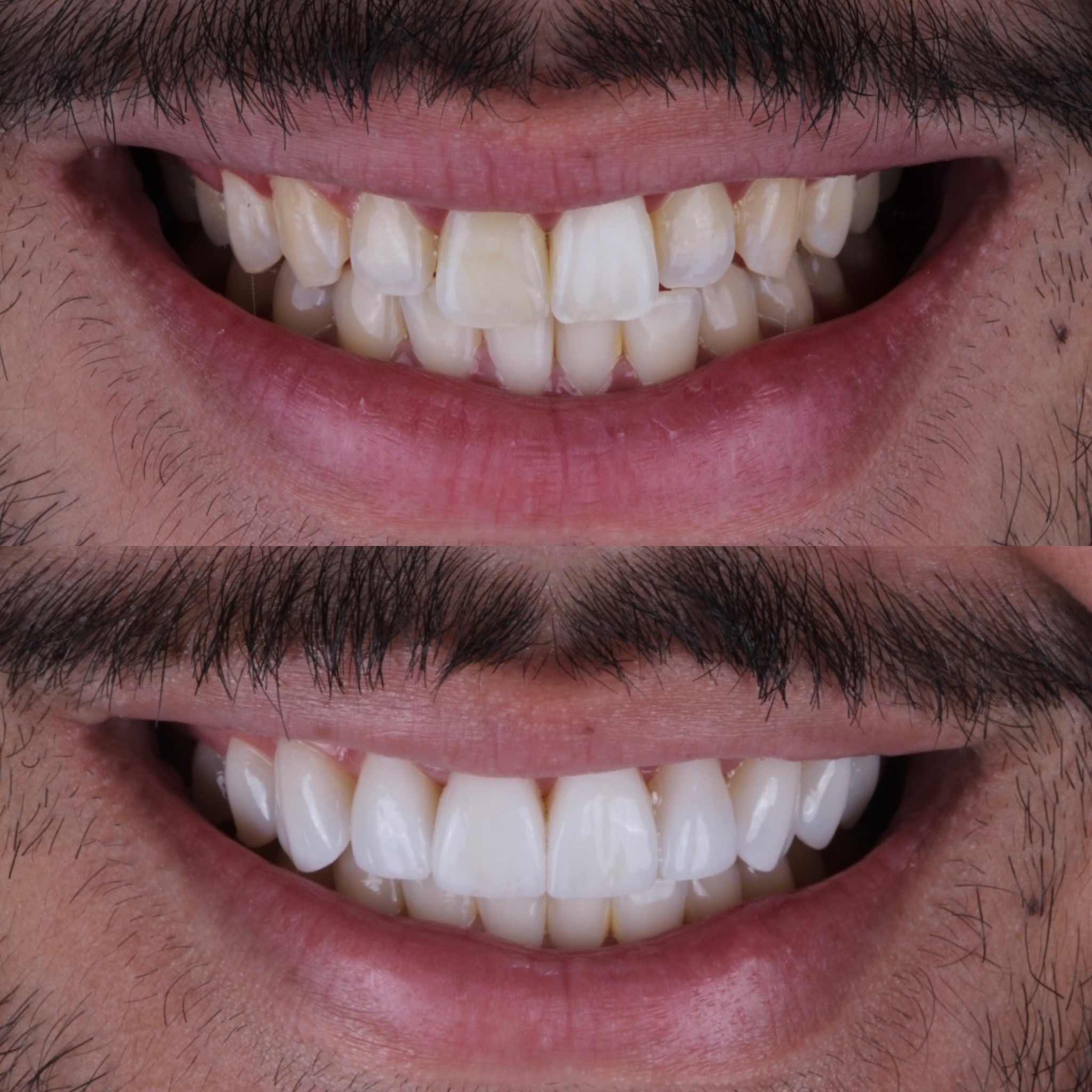 Resultado real de sorriso transformado