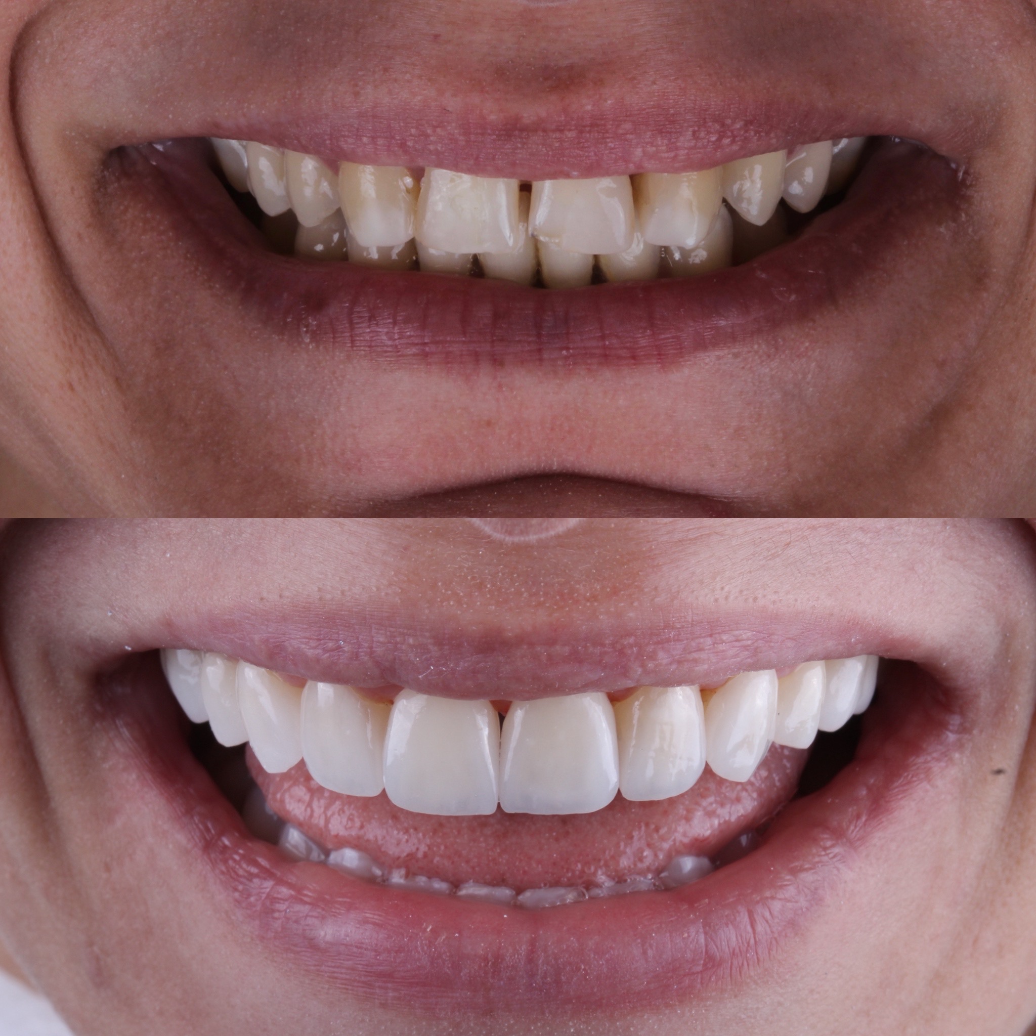 Resultado real de sorriso transformado