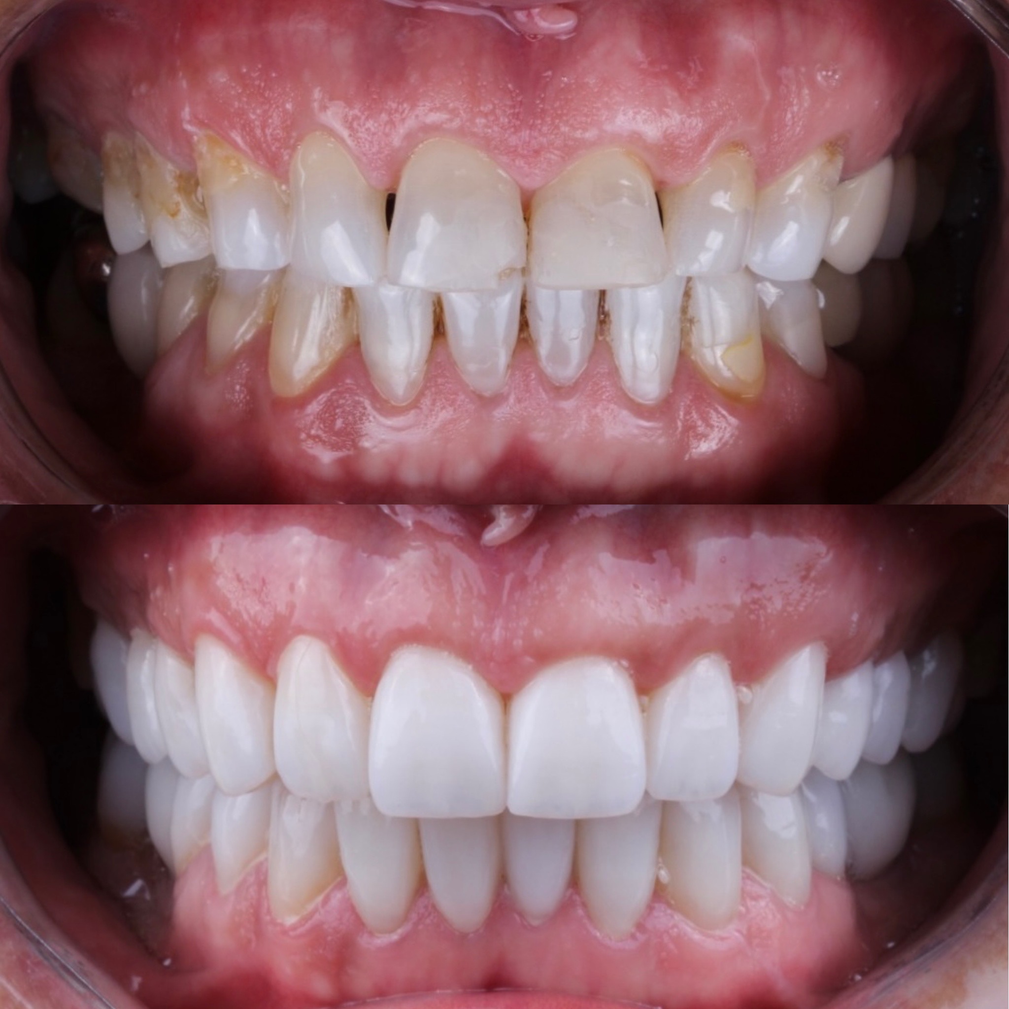 Resultado real de sorriso transformado