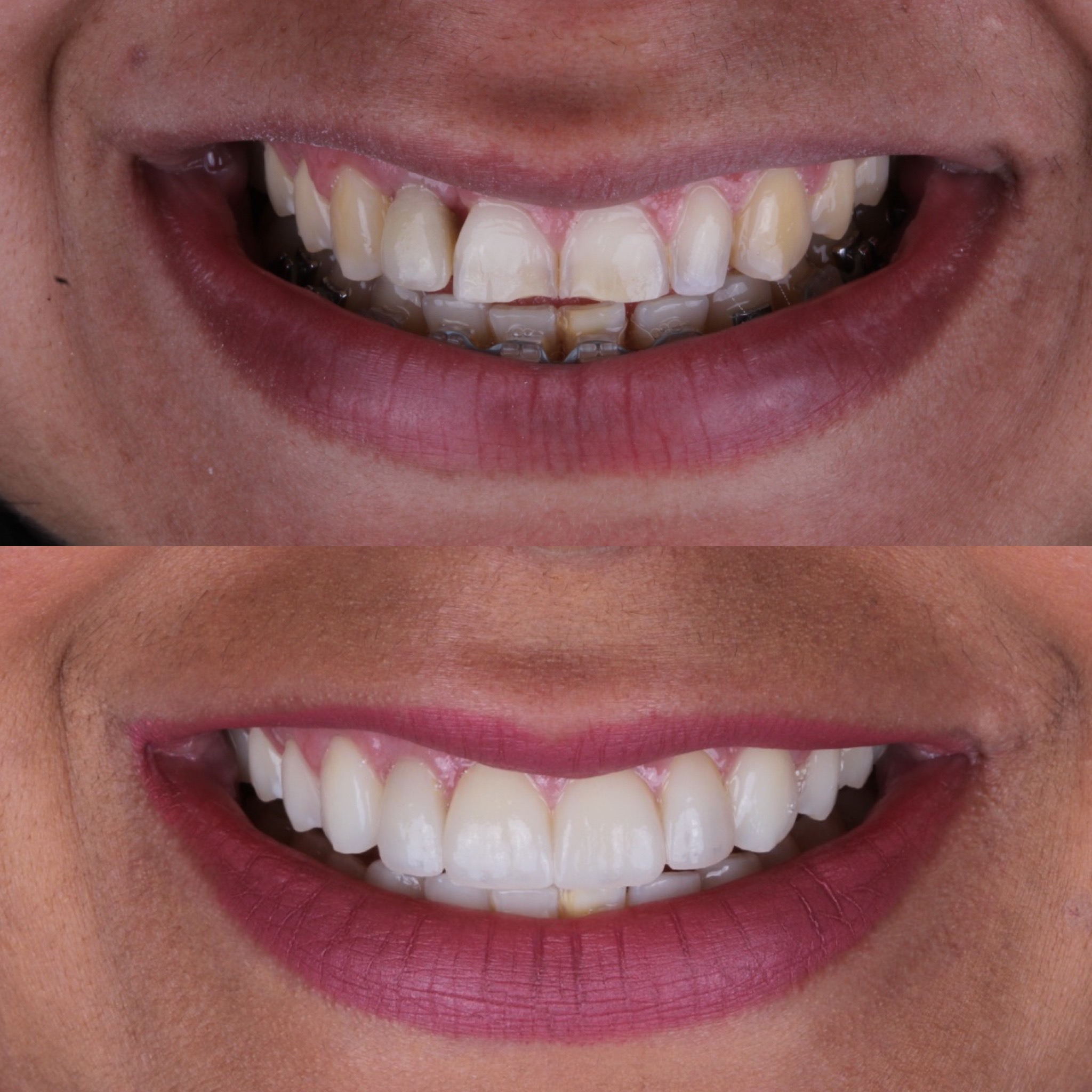 Facetas de porcelana