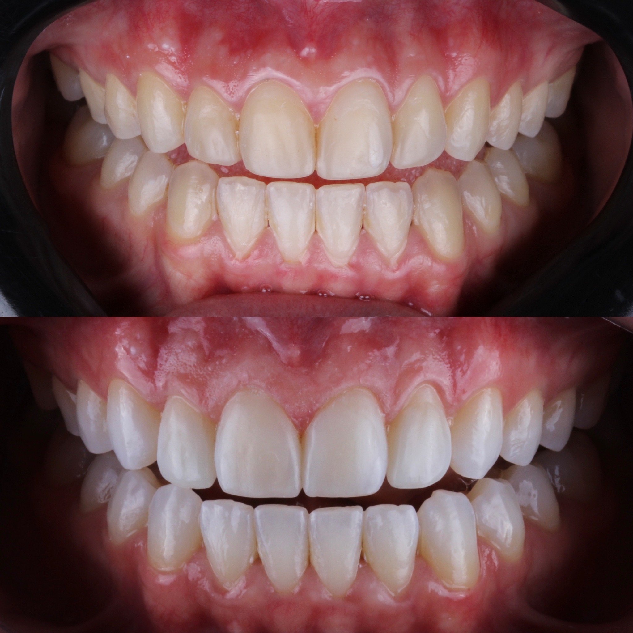 Lentes de contato dental em porcelana